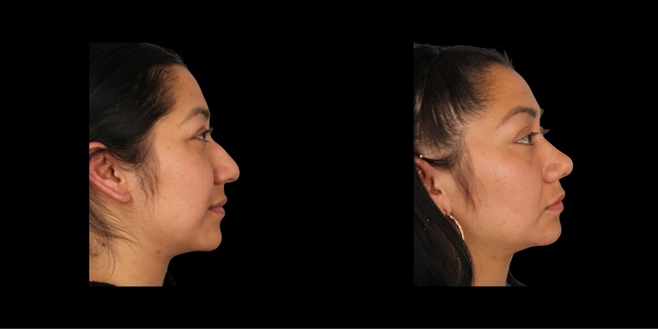 Rhinoplasty before-and-after composite, Consona Plastic Surgery – case 3, view 3