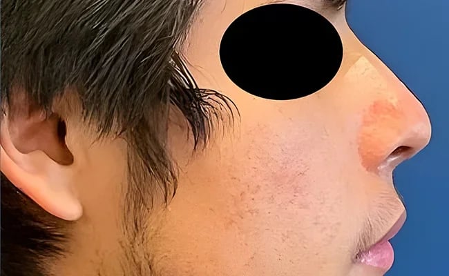 Rhinoplasty after surgery – Murrieta Facial Plastic Surgery, case 11