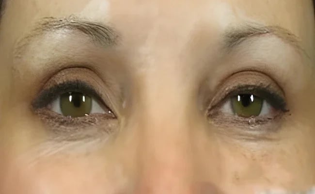 Eyelid Surgery after surgery – Murrieta Facial Plastic Surgery, case 22