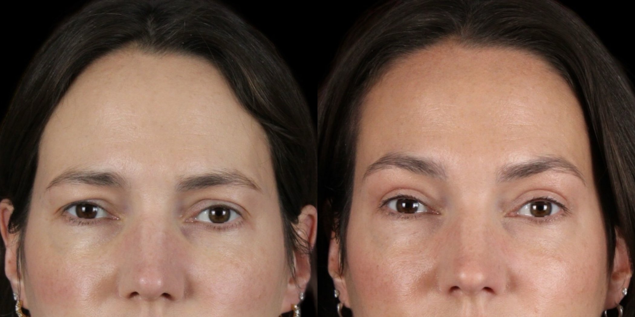 Blepharoplasty before-and-after composite, Consona Plastic Surgery – case 4, view 1