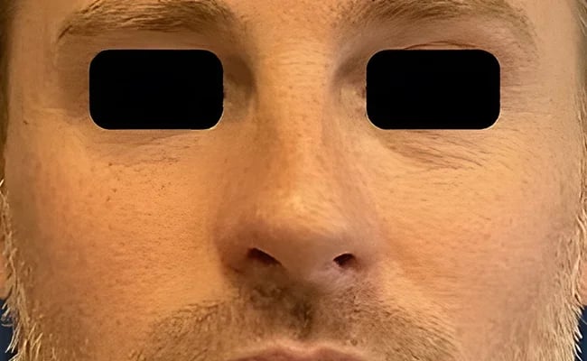 Rhinoplasty before surgery – Murrieta Facial Plastic Surgery, case 3