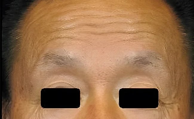Brow Lift before surgery – Murrieta Facial Plastic Surgery, case 3