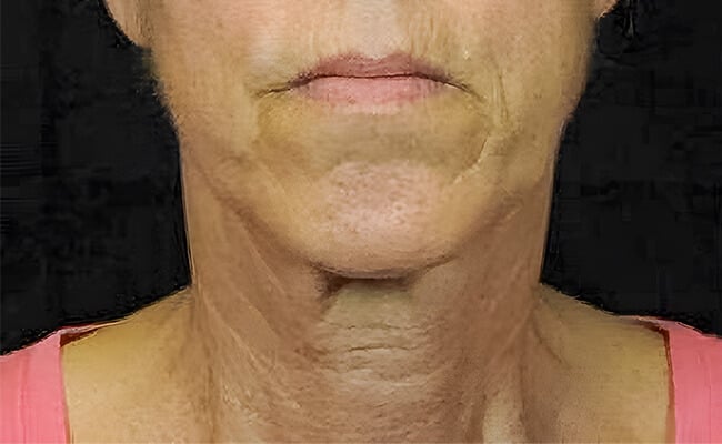 Neck Lift before surgery – Murrieta Facial Plastic Surgery, case 4