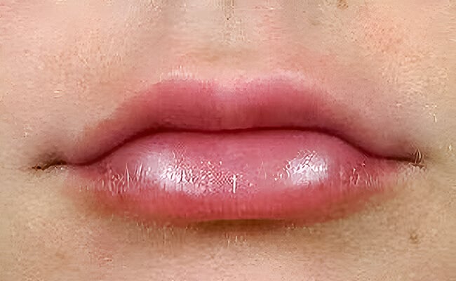 Fillers after treatment – Murrieta Facial Plastic Surgery, case 1