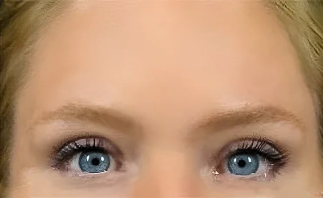 Brow Lift after surgery – Murrieta Facial Plastic Surgery, case 5