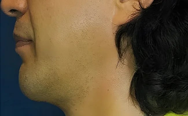 Chin Augmentation after surgery – Murrieta Facial Plastic Surgery, case 7