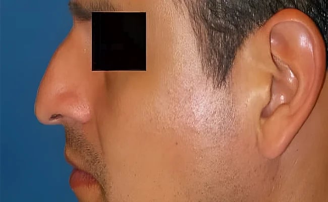Rhinoplasty before surgery – Murrieta Facial Plastic Surgery, case 16