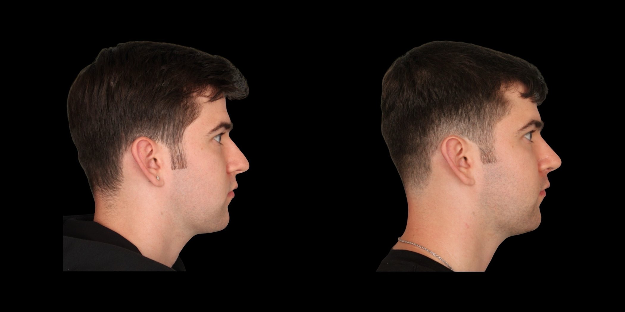 Rhinoplasty before-and-after composite, Consona Plastic Surgery – case 2, view 2