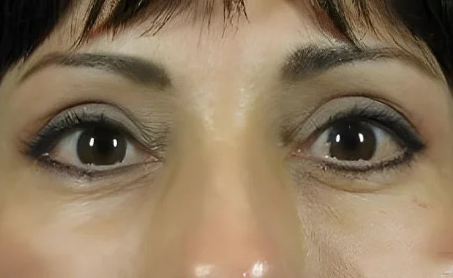Eyelid Surgery after surgery – Murrieta Facial Plastic Surgery, case 15