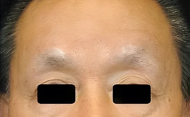 Brow Lift after surgery – Murrieta Facial Plastic Surgery, case 3