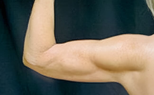 Liposuction after surgery – Murrieta Facial Plastic Surgery, case 2