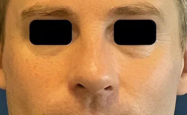 Rhinoplasty after surgery – Murrieta Facial Plastic Surgery, case 3