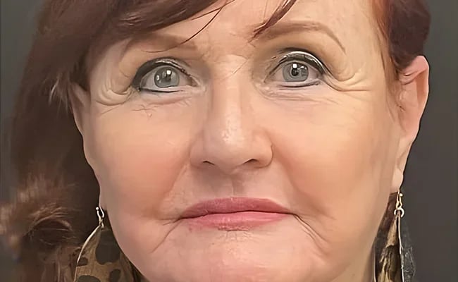 Facelift after surgery – Murrieta Facial Plastic Surgery, case 24