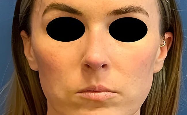 Rhinoplasty after surgery – Murrieta Facial Plastic Surgery, case 1