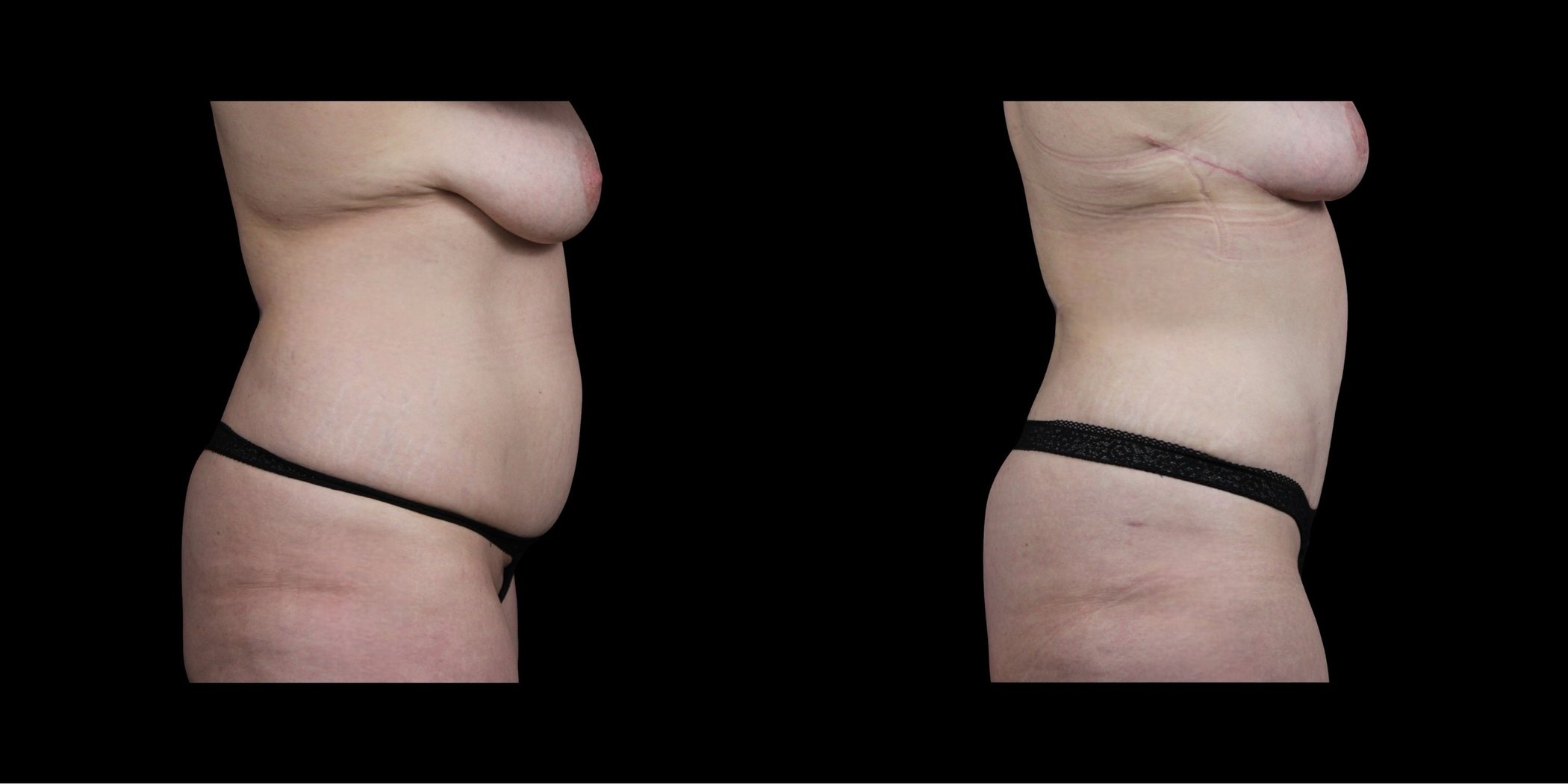 Abdominoplasty before-and-after composite, Consona Plastic Surgery – case 2, view 3