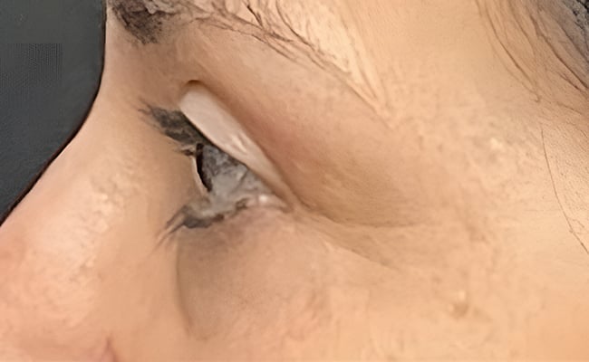 Eyelid Surgery after surgery – Murrieta Facial Plastic Surgery, case 2