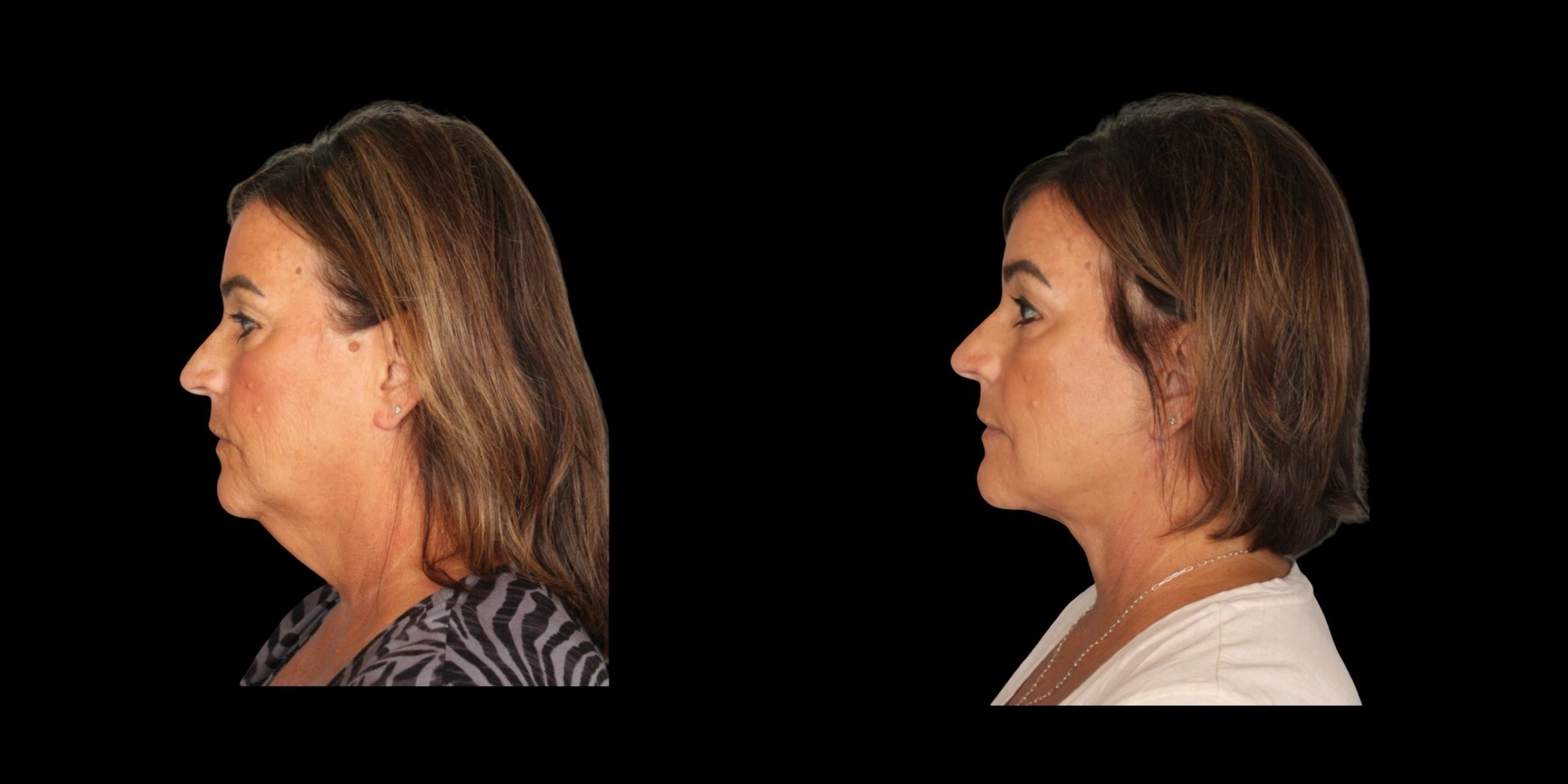 Face & Neck Lift before-and-after composite, Consona Plastic Surgery – case 3, view 2