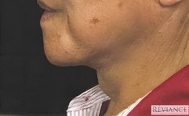 Neck Lift after surgery – Murrieta Facial Plastic Surgery, case 5