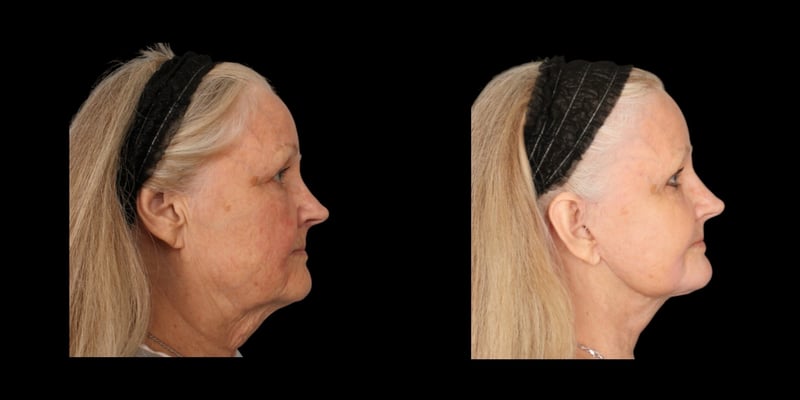 Face & Neck Lift before-and-after composite, Consona Plastic Surgery – case 1, view 1