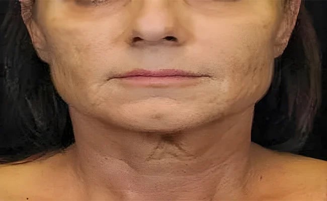 Facelift before surgery – Murrieta Facial Plastic Surgery, case 18