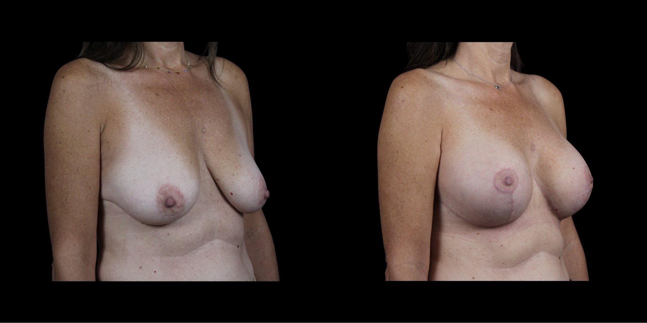 Augmentation Mastopexy before-and-after composite, Consona Plastic Surgery – case 5, view 2