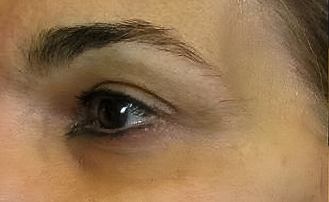 Fillers before treatment – Murrieta Facial Plastic Surgery, case 3
