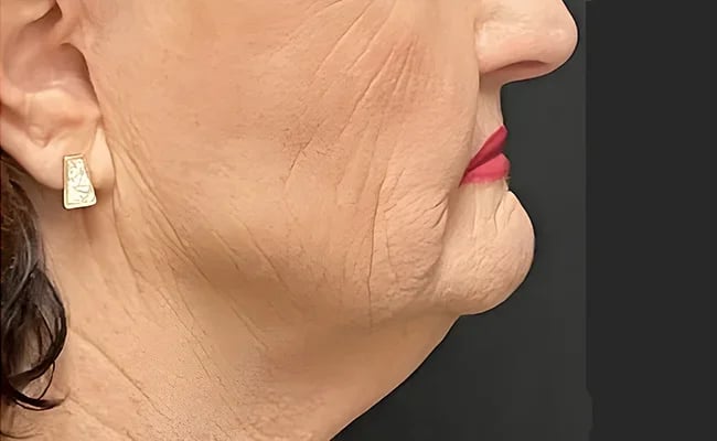 Facelift before surgery – Murrieta Facial Plastic Surgery, case 7