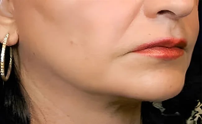 Facelift after surgery – Murrieta Facial Plastic Surgery, case 2