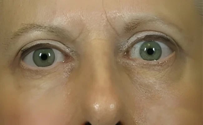Eyelid Surgery after surgery – Murrieta Facial Plastic Surgery, case 16