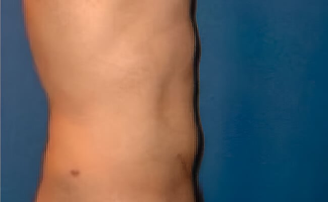 Liposuction after surgery – Murrieta Facial Plastic Surgery, case 5