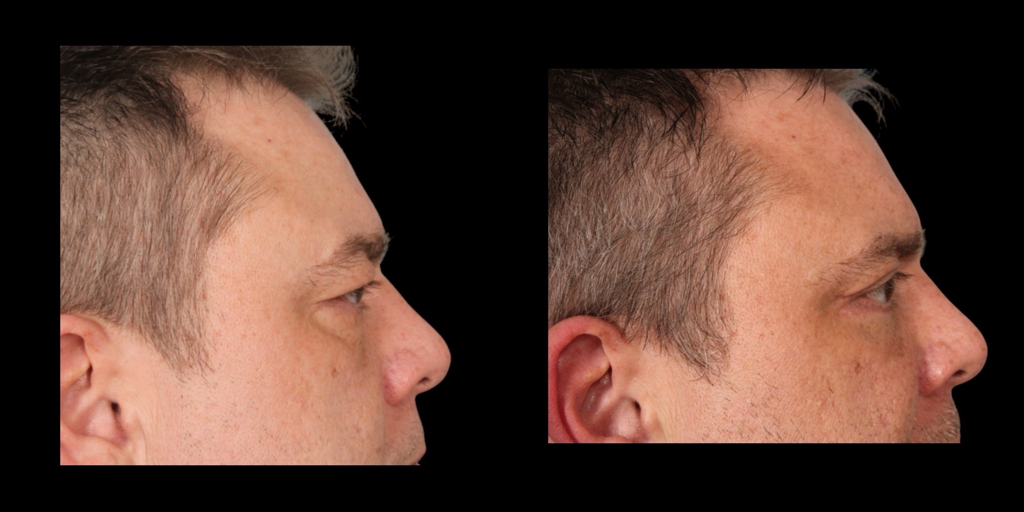 Blepharoplasty before-and-after composite, Consona Plastic Surgery – case 2, view 3