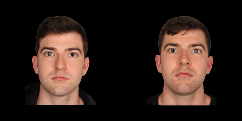 Rhinoplasty before-and-after composite, Consona Plastic Surgery – case 2, view 1