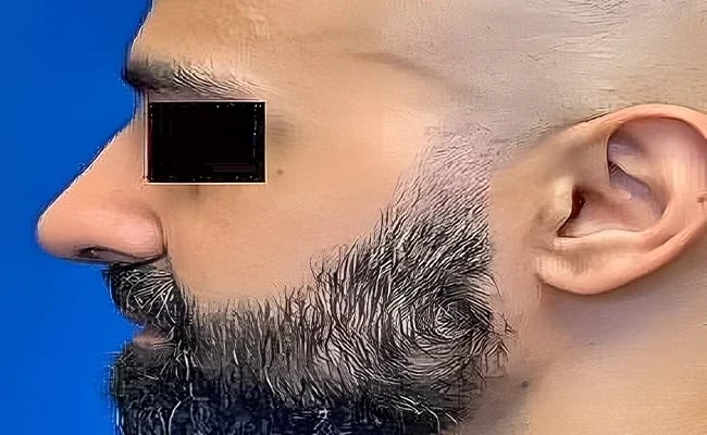 Rhinoplasty after surgery – Murrieta Facial Plastic Surgery, case 18