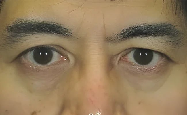 Eyelid Surgery before surgery – Murrieta Facial Plastic Surgery, case 23