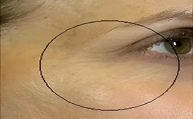 Eyelid Surgery after surgery – Murrieta Facial Plastic Surgery, case 13