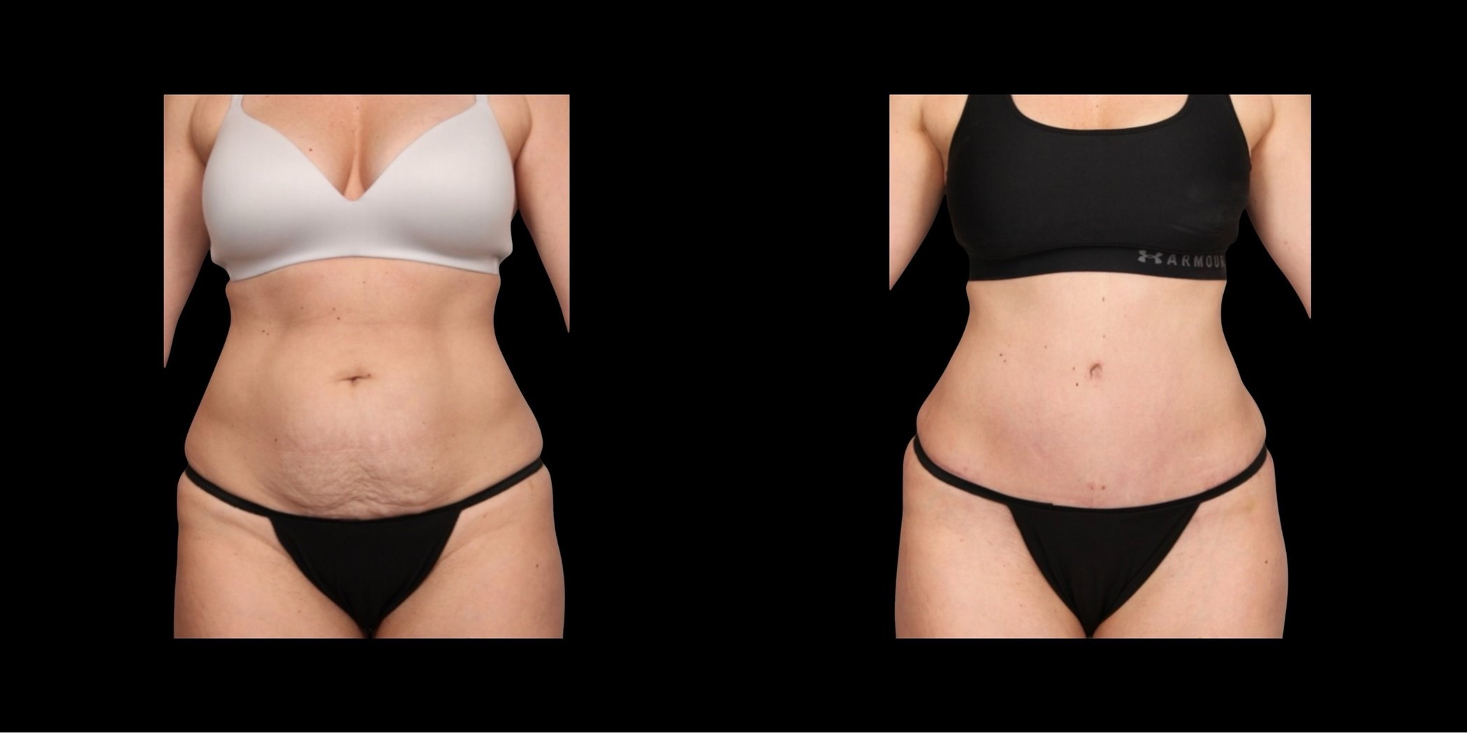 Abdominoplasty before-and-after composite, Consona Plastic Surgery – case 3, view 1