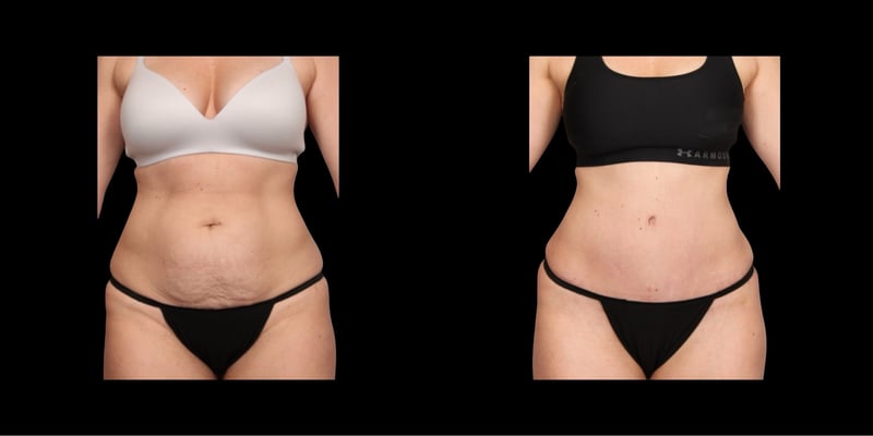 Abdominoplasty before-and-after composite, Consona Plastic Surgery – case 3, view 1