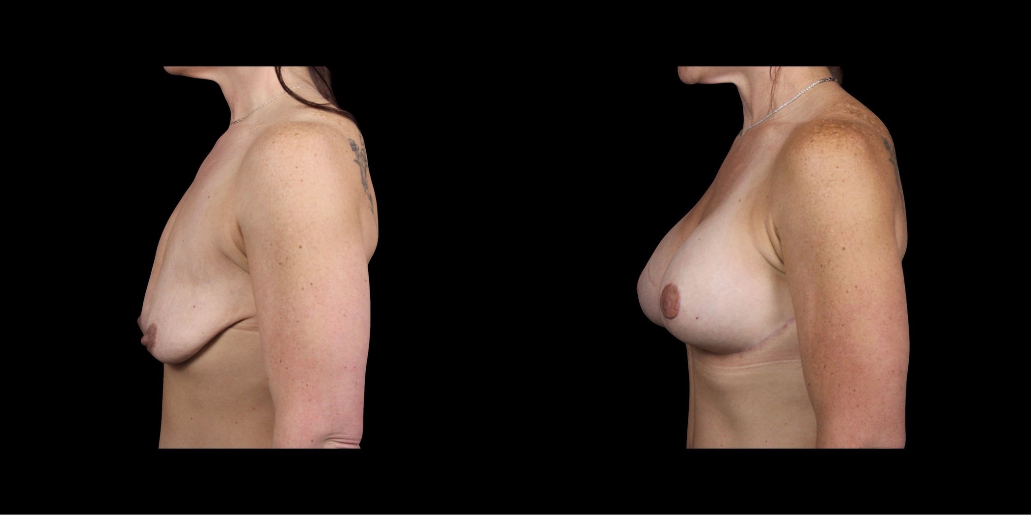 Augmentation Mastopexy before-and-after composite, Consona Plastic Surgery – case 4, view 2