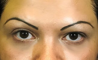 Vampire Facelift before treatment – Murrieta Facial Plastic Surgery, case 1