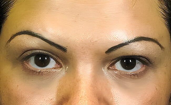 Vampire Facelift before treatment – Murrieta Facial Plastic Surgery, case 1