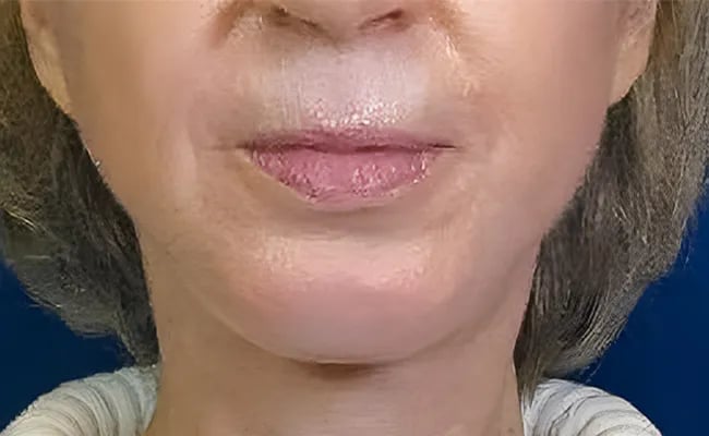 Chin Augmentation after surgery – Murrieta Facial Plastic Surgery, case 2