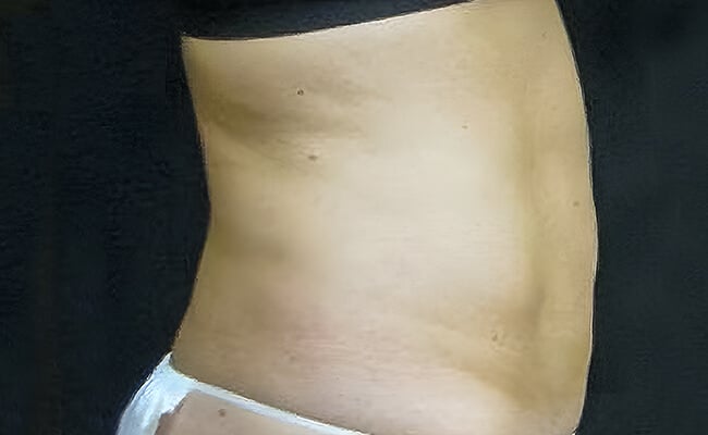 Liposuction after surgery – Murrieta Facial Plastic Surgery, case 1