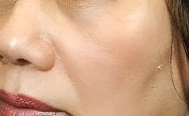 Facial Fat Grafting before surgery – Murrieta Facial Plastic Surgery, case 2