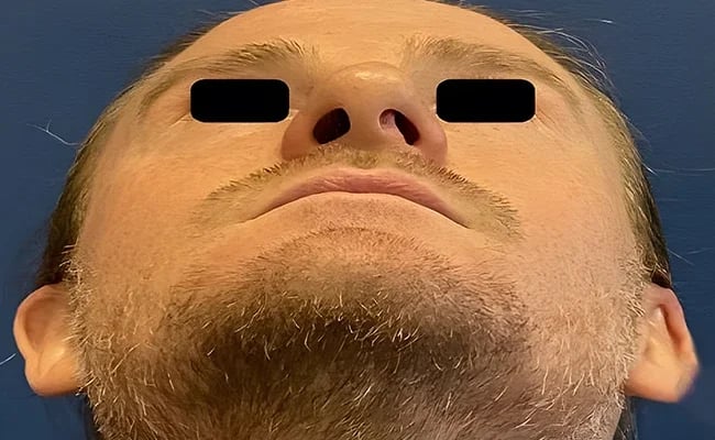Rhinoplasty before surgery – Murrieta Facial Plastic Surgery, case 4