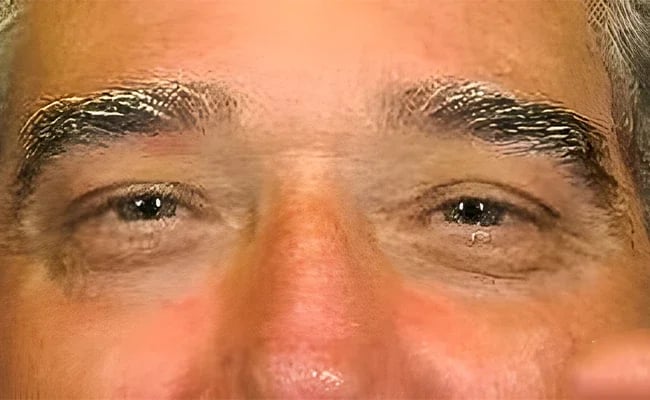 Eyelid Surgery after surgery – Murrieta Facial Plastic Surgery, case 8