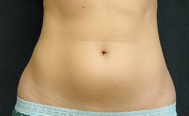 Liposuction before surgery – Murrieta Facial Plastic Surgery, case 3