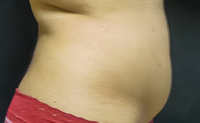Liposuction before surgery – Murrieta Facial Plastic Surgery, case 8