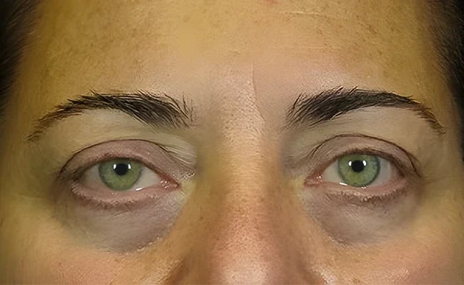 Eyelid Surgery before surgery – Murrieta Facial Plastic Surgery, case 14