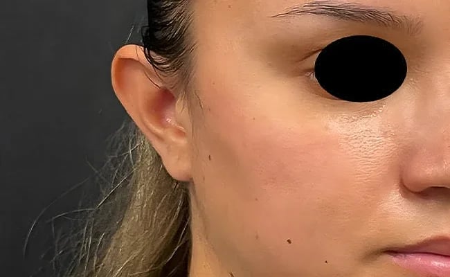 Ear Surgery before surgery – Murrieta Facial Plastic Surgery, case 1