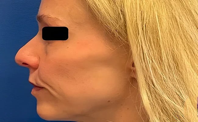 Rhinoplasty before surgery – Murrieta Facial Plastic Surgery, case 7